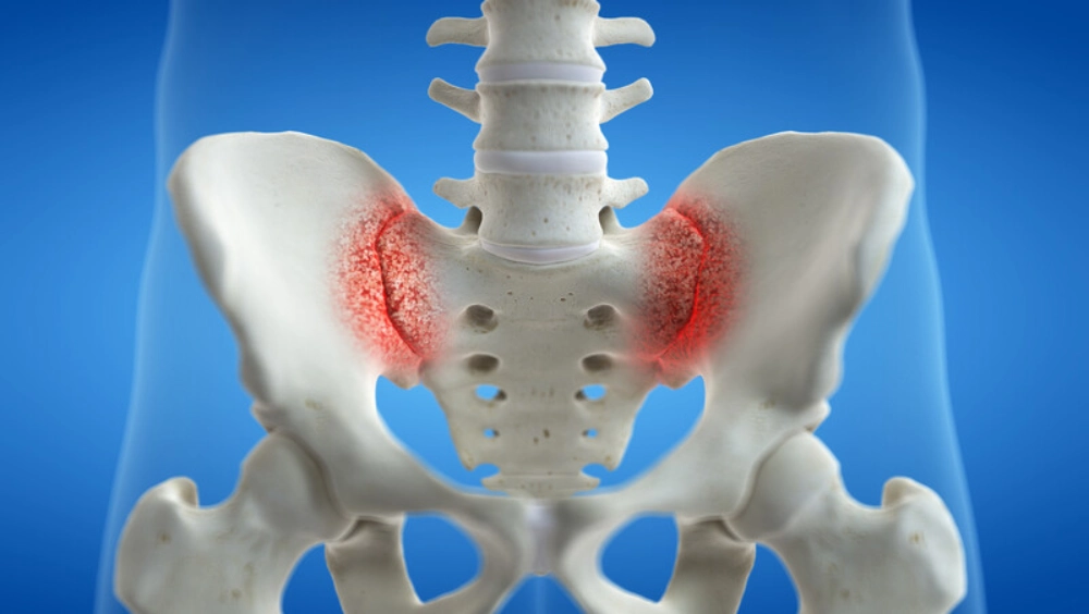 What Is SI Joint Dysfunction?